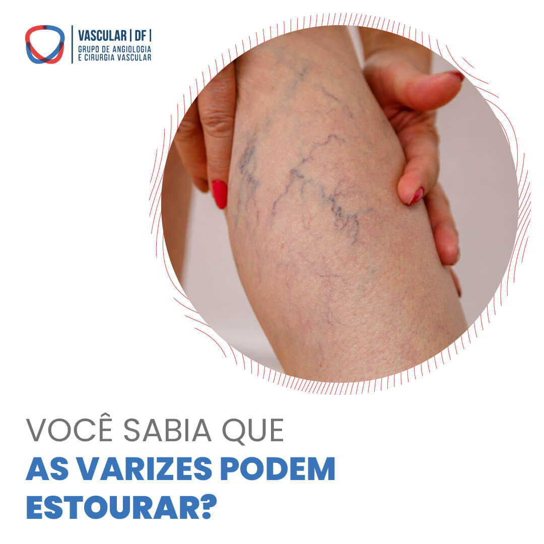 VOCÊ SABIA QUE AS VARIZES PODEM ESTOURAR?