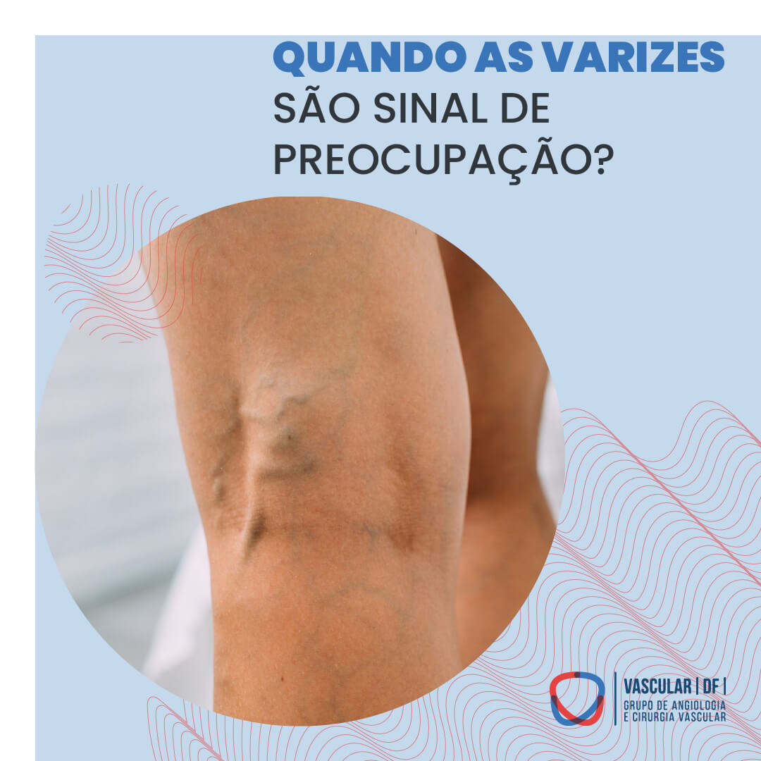 QUANDO AS VARIZES SÃO SINAL DE PREOCUPAÇÃO?